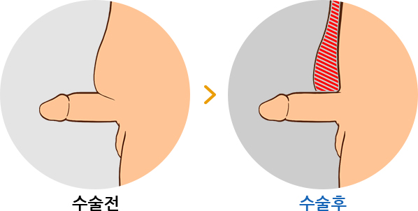 하이맨 함몰음경교정 길이연장술 수술 전 / 후