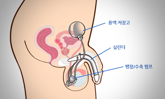 리저브(물주머니)/실린더/펌프(스위치) 세가지 부위로 나뉩니다.