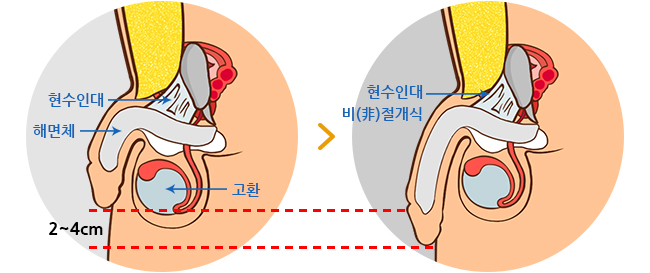 하이맨 자라고추교정 길이연장술