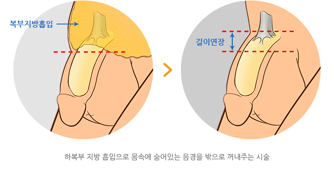 하이맨 함몰음경교정 길이연장술 - 하복부 지방 흡입으로 몸속에 숨어있는 음경을 밖으로 꺼내주는 시술