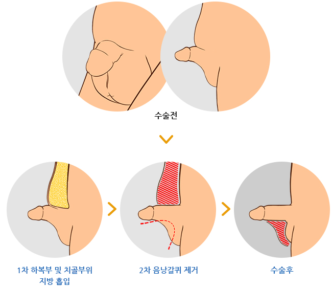 1차 하복부 및 치골부위 지방 흡입 / 2차 음낭갈퀴 제거 / 수술후 