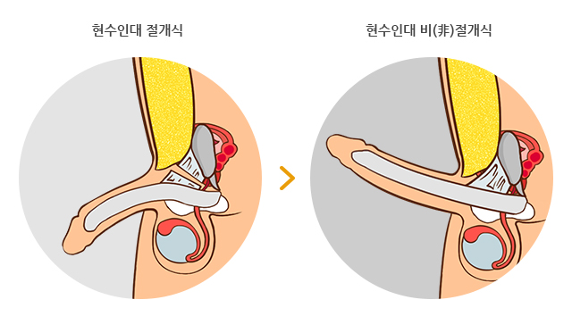 하이맨 자라고추교정 길이연장술