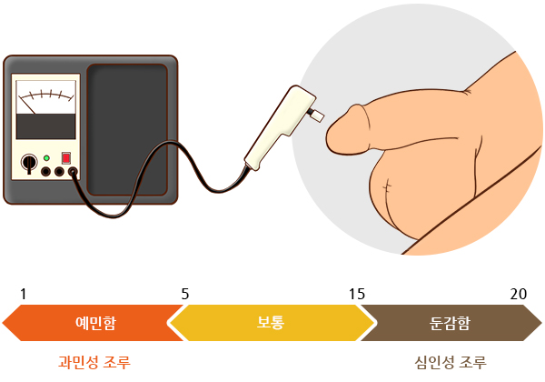 조루증 검사방법