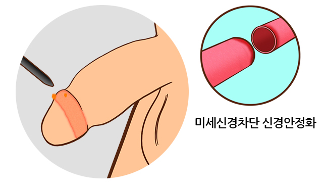 귀두박리조투수술