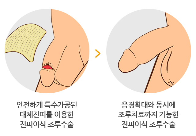 진피이식조루수술